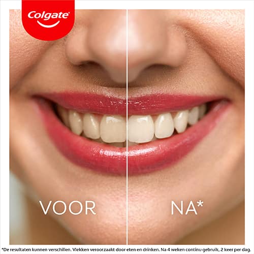 Colgate Max White LED Whitening Kit